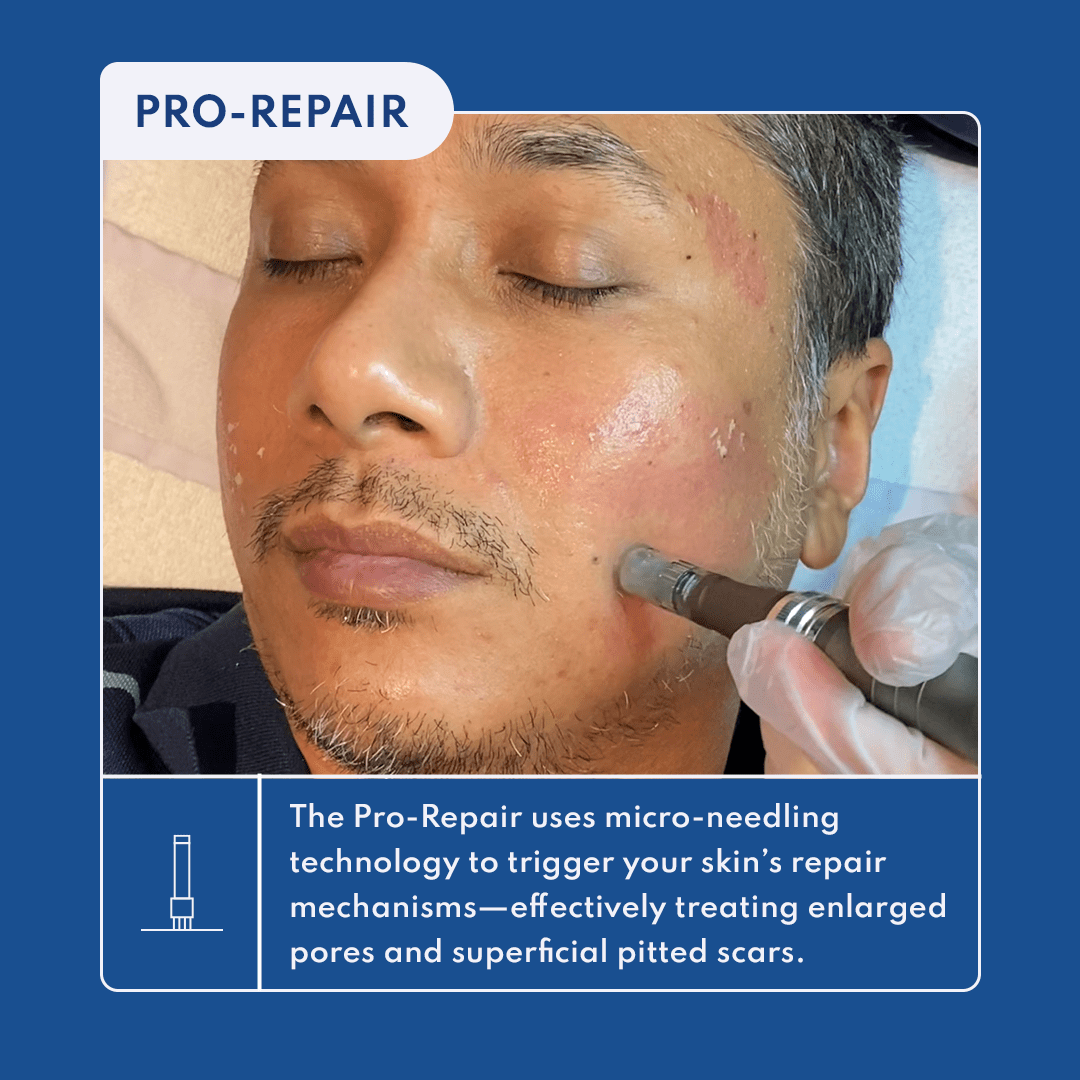 Remedy's 360° Acne Scar Treatments, Explained